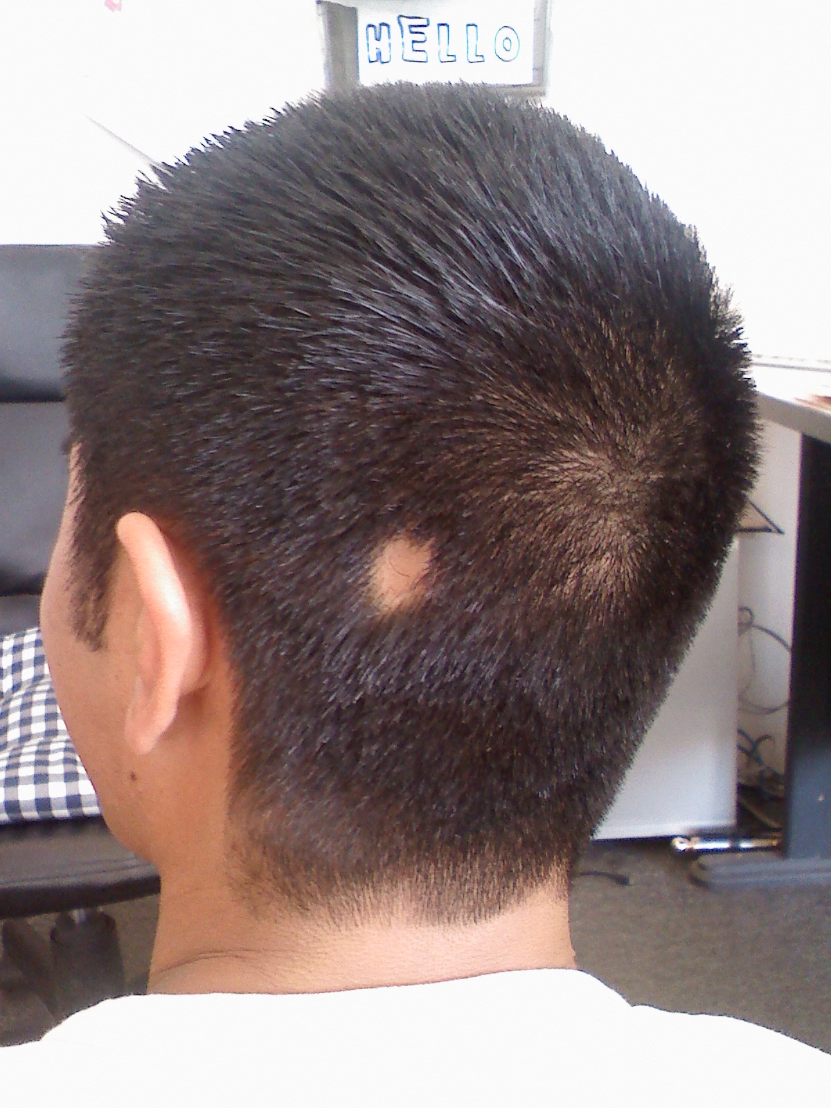Alopecia areata causing a distinct bald patch on the back of an adult's head