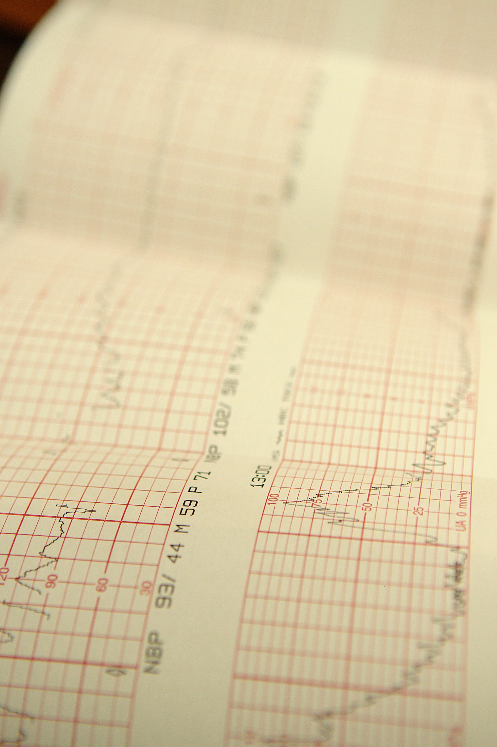 A cardiotocography printout recording fetal heart rate and contractions during labour.