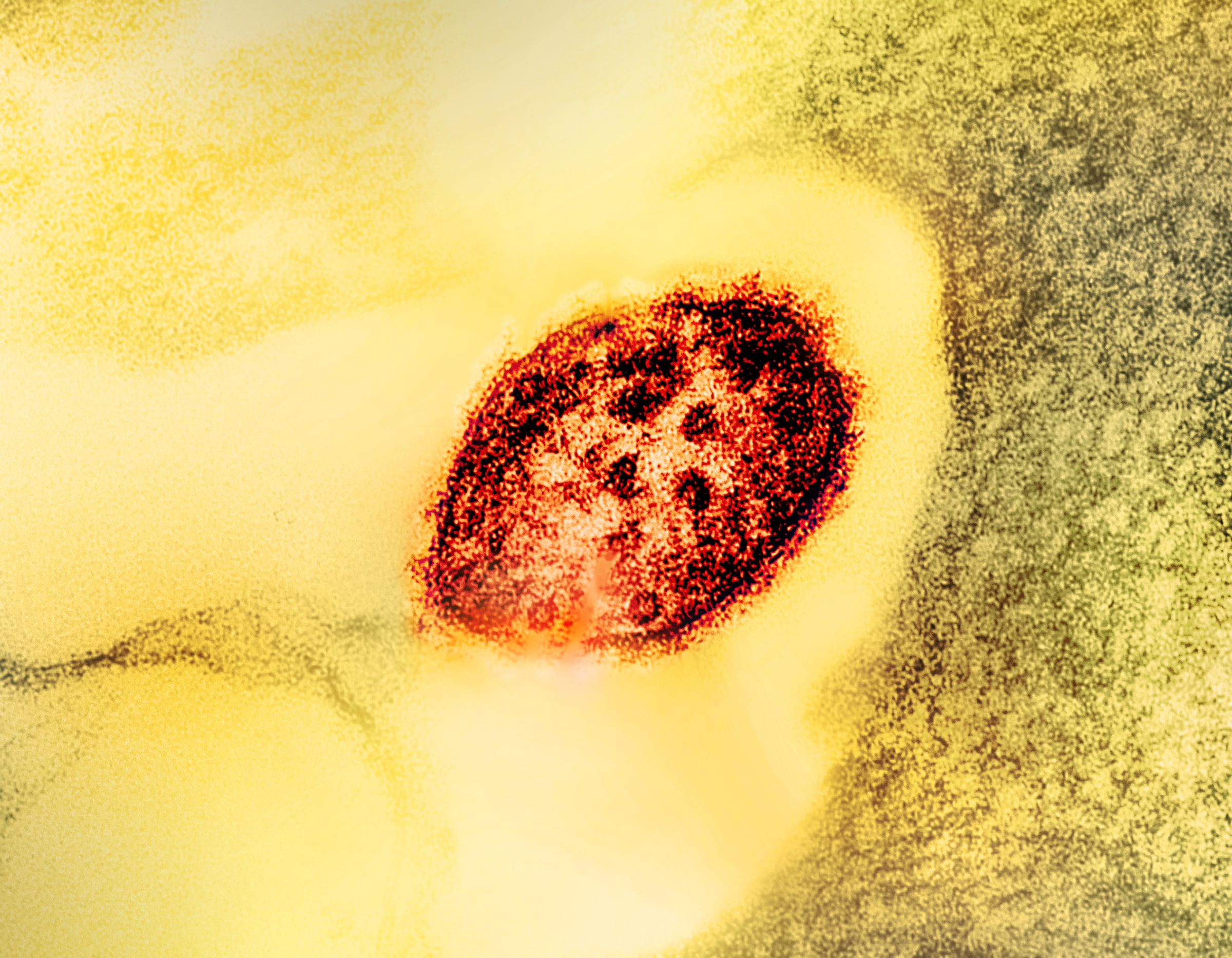 A colour laboratory micrograph shows a single measles virus particle.