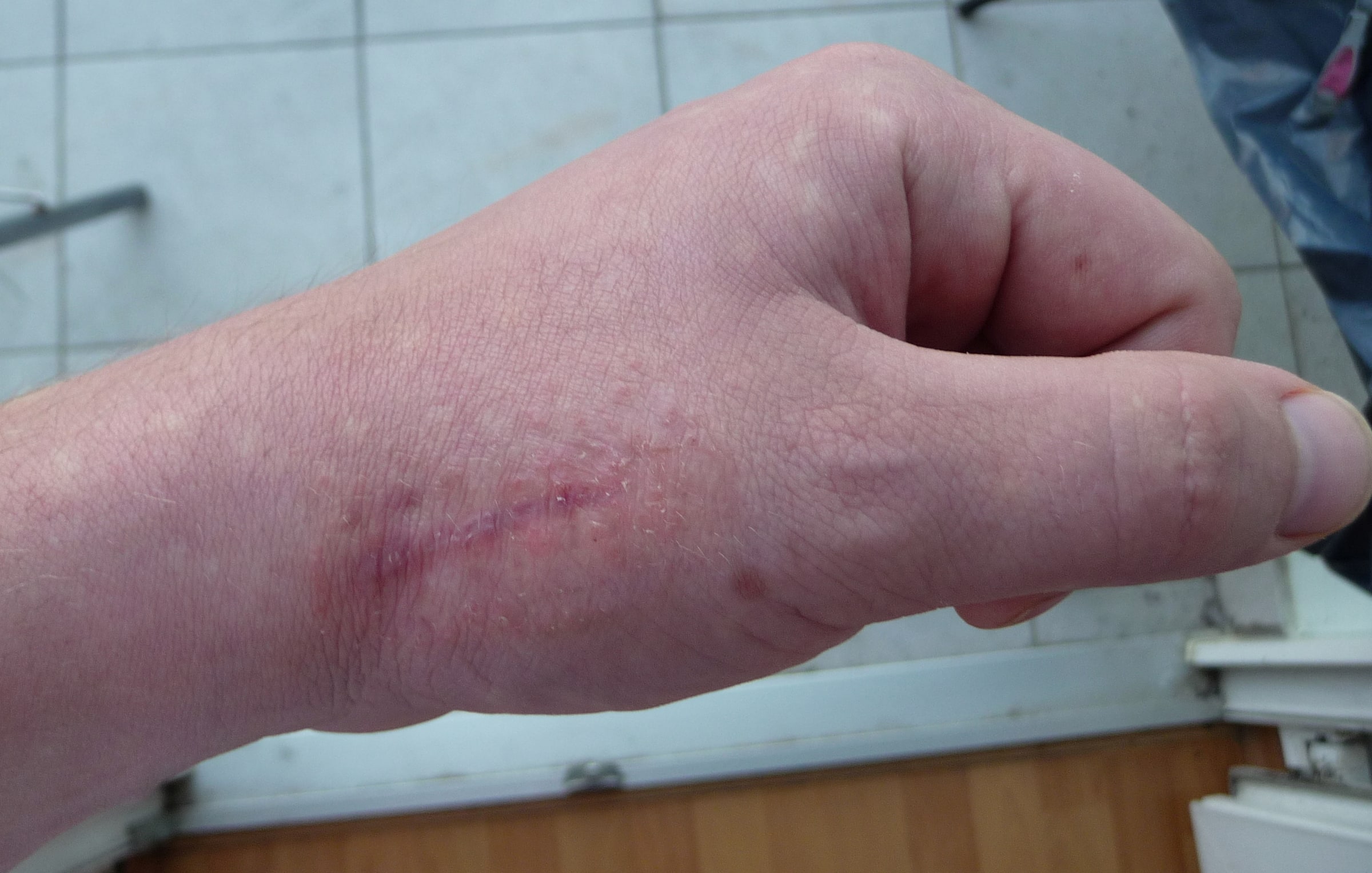 A closed pink scar on the back of a hand.