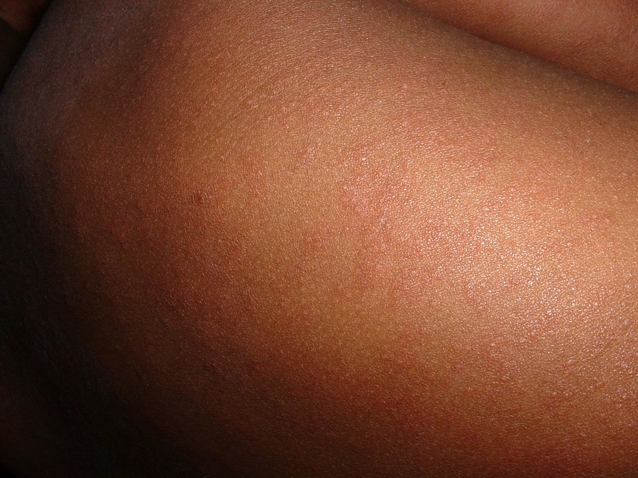 Measles rash on an anonymous area of skin, photographed in Nigeria in February 2002.
